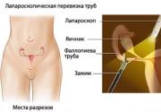 Беременность после стерилизации: Возможно ли зачать, Перевязка труб во время кесарева сечения, Как забеременеть Можно ли забеременеть после стерилизации естественным путем